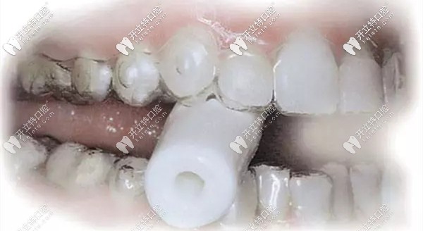 想要牙套貼合咬膠很重要