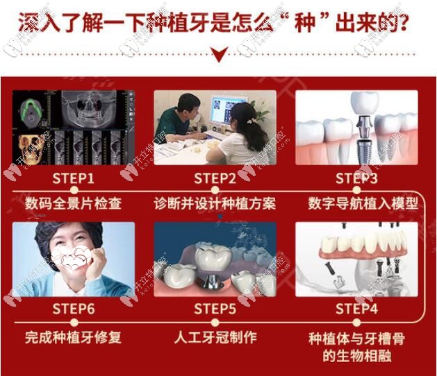 種植牙手術(shù)過(guò)程圖解 種植牙手術(shù)過(guò)程圖解