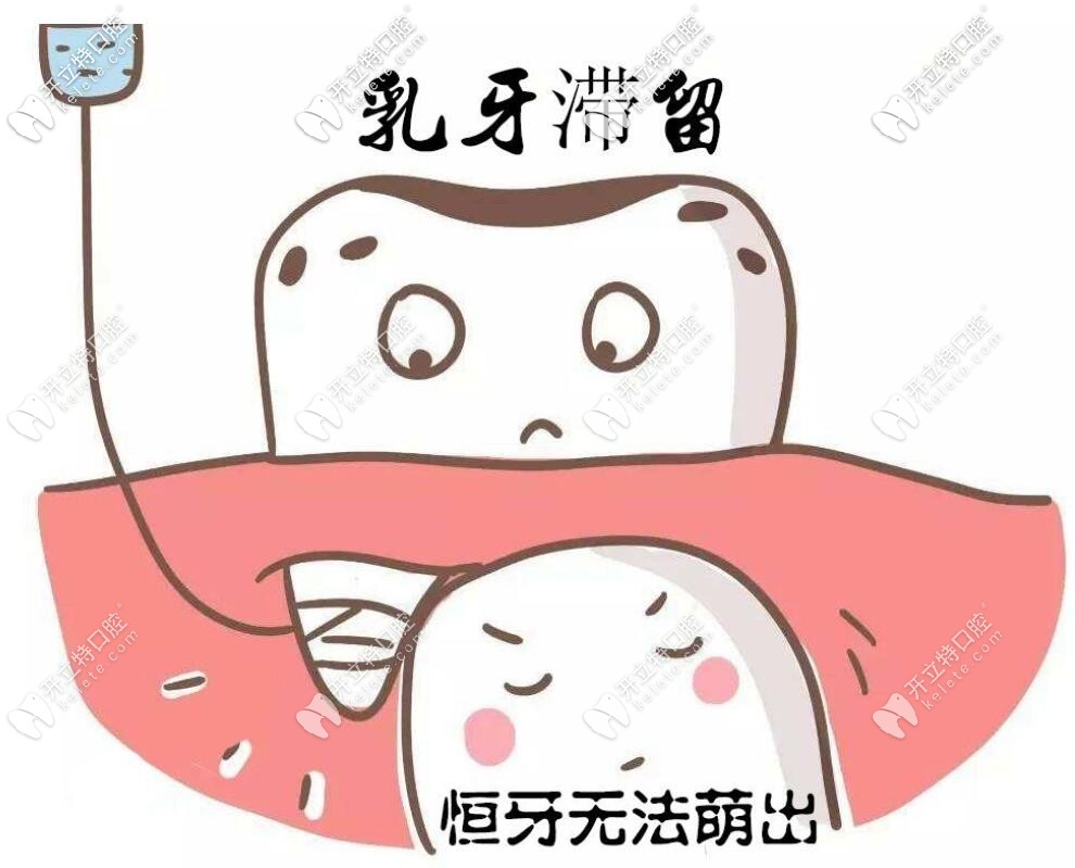 乳牙滯留的圖片