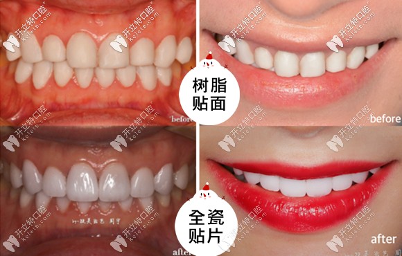 樹脂貼面和全瓷貼面的效果對(duì)比