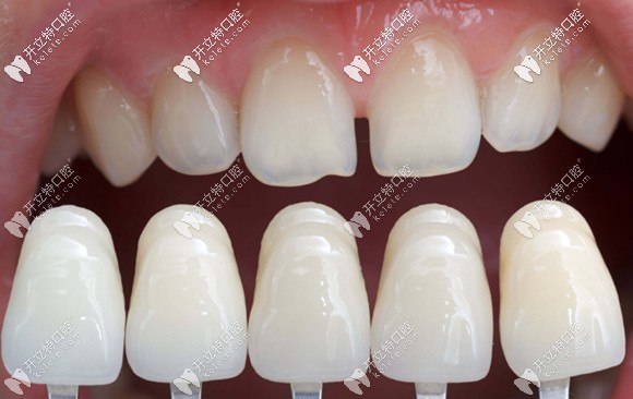 全瓷貼片在臨床中的應(yīng)用