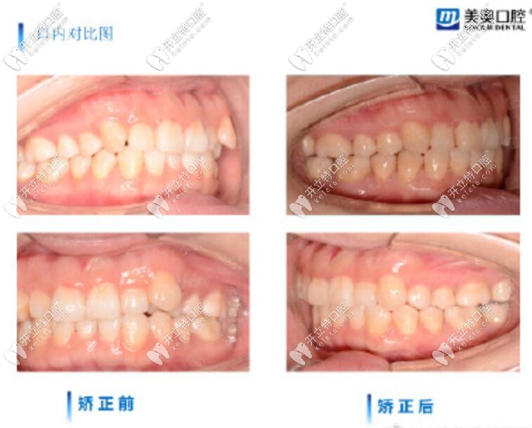 長沙美奧口腔時代天使矯正案例