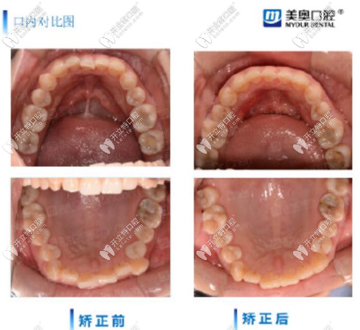 長沙美奧口腔時代天使推磨牙案例