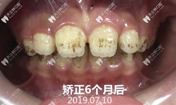 兒童早期矯正半年的效果