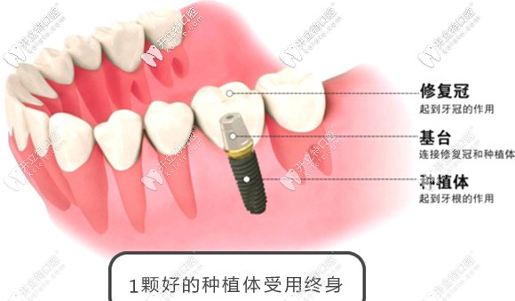 韓國奧齒泰種植體+烤瓷冠才3980元起