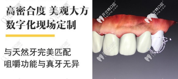 澤康、威蘭德、吉爾巴赫全瓷牙該選哪個牌子