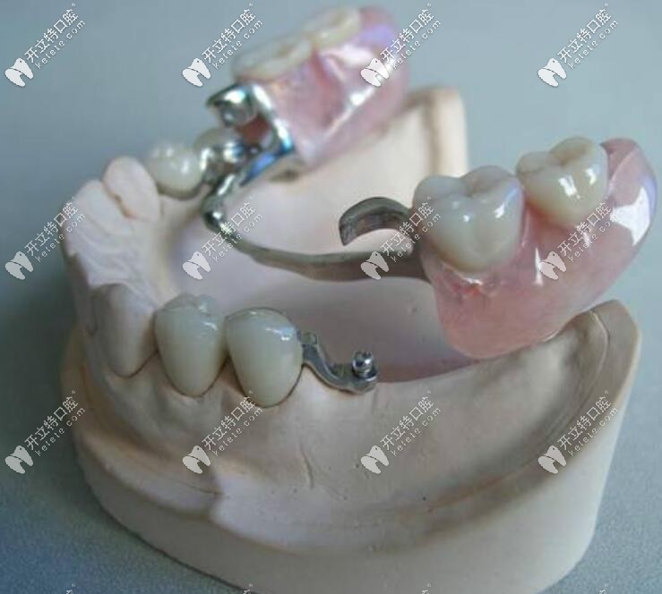 精密附著體義齒2萬有人說貴,原來正是這些缺點(diǎn)影響它的價格