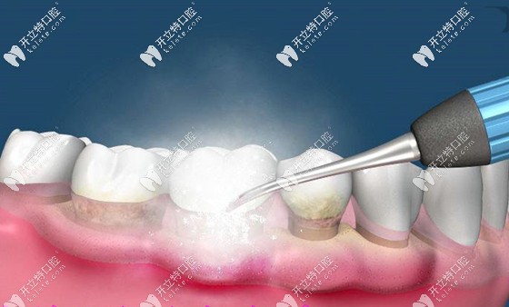 定期洗牙是預(yù)防牙病的關(guān)鍵