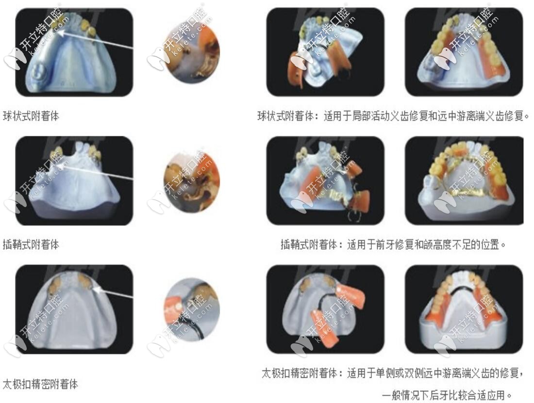 不同精密附著體適應(yīng)癥