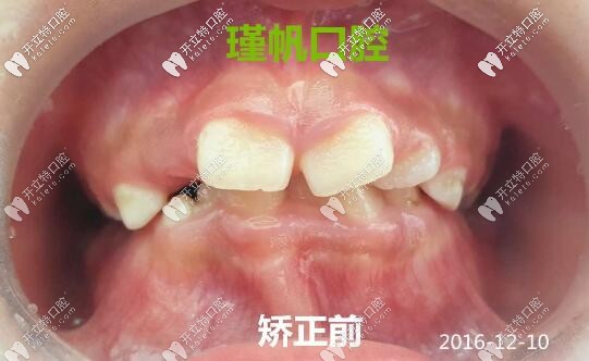孩子牙列畸形在換牙期做矯正的效果勝過(guò)整容,不信進(jìn)來(lái)瞧
