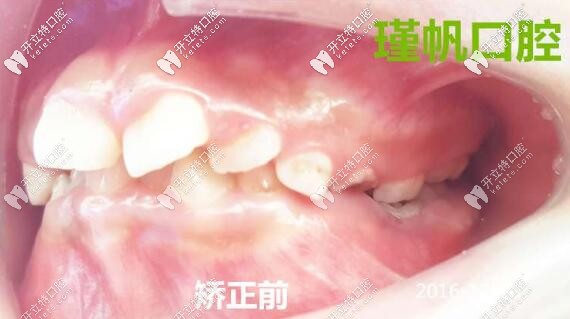 牙齒畸形矯正前側(cè)面照片
