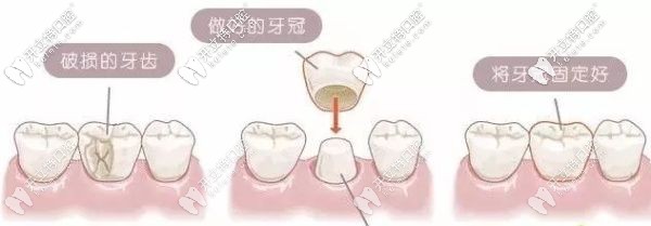 解答：門(mén)牙缺了一小塊是選牙齒貼面還是全瓷牙好呢？