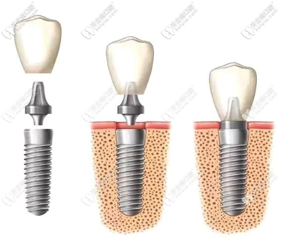 種植體埋入牙槽骨過(guò)程