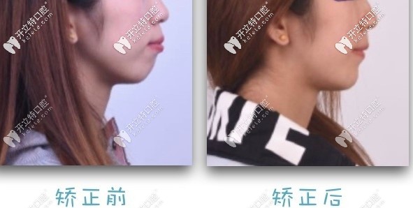 北京勁松口腔牙齒矯正真人案例
