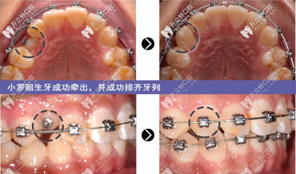 治療8個(gè)月，阻生牙成功牽出并成功排齊牙列