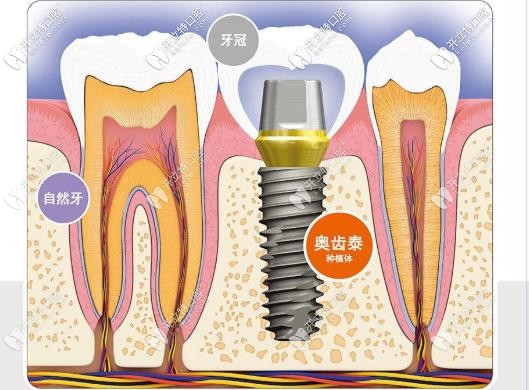 奧齒泰種植體外觀