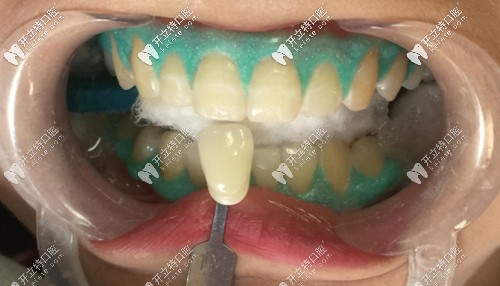 藝星口腔的皓齒美白特色 藝星口腔的皓齒美白特色