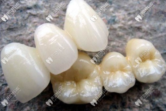 純鈦烤瓷牙的優(yōu)點(diǎn)