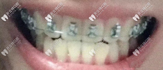 下牙終于出來了