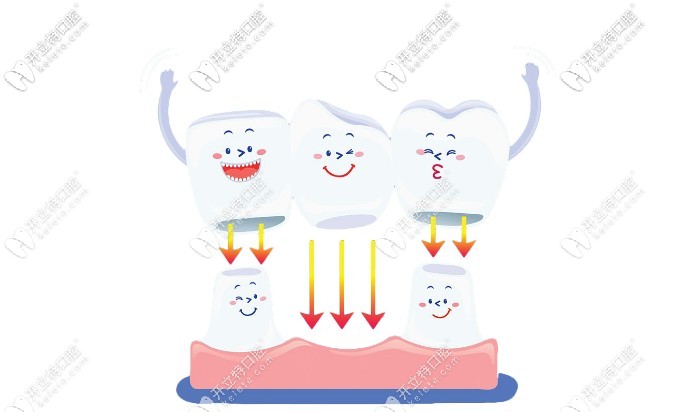 純鈦烤瓷牙和全瓷牙的價(jià)格