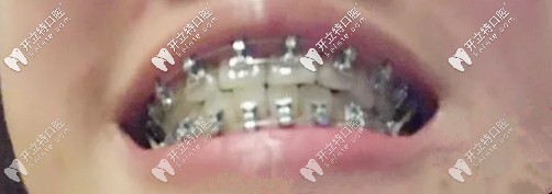 活動翼矯正490天