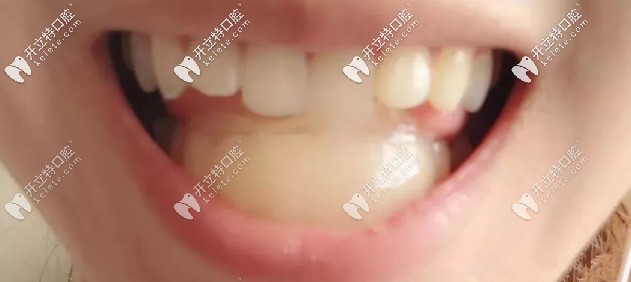 目的是把下牙拉出來