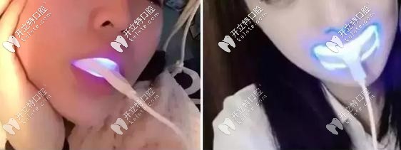 美牙儀會導(dǎo)致牙齦萎縮