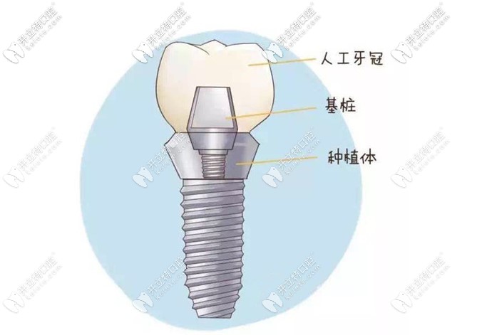 北京瑞士iti種植牙多少錢