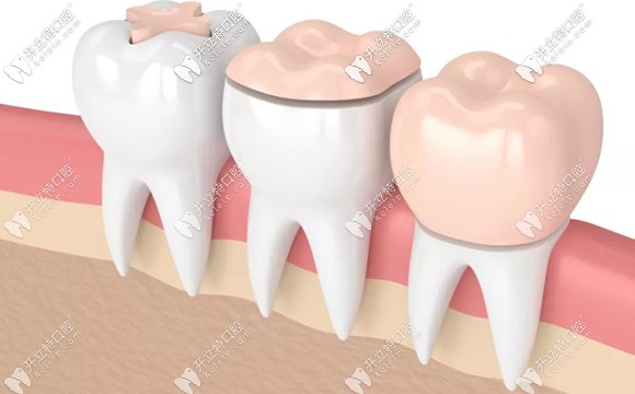 好的牙冠材料生物相容性才好