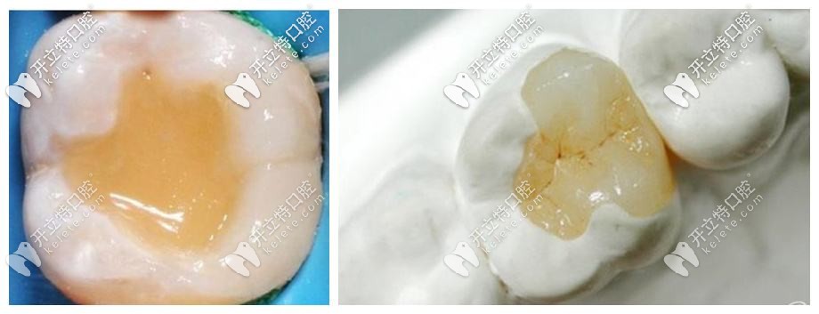 嵌體為什么老掉呢?假如牙嵌體掉了再粘回去要錢嗎？