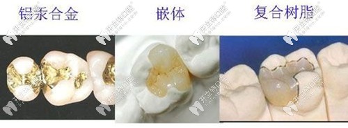 補牙的各種材料