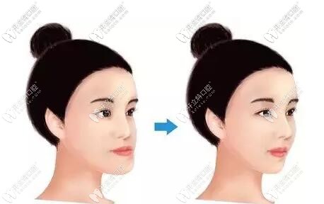 牙齒矯正和瘦臉沒關(guān)系