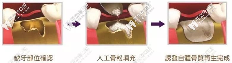 植骨粉種植牙過程 植骨粉種植牙過程