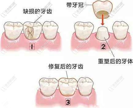 選擇美容冠要慎重