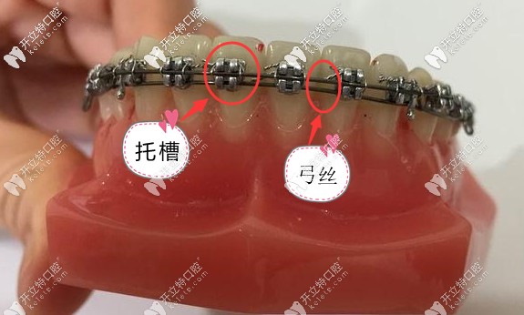 牙齒矯正中的方絲弓和直絲弓托槽的粘結有何不同?