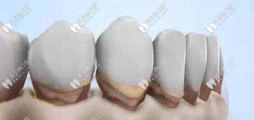 牙齦萎縮外觀示意圖 牙齦萎縮外觀示意圖