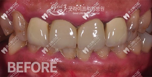 做牙齒貼面前牙齒狀態(tài)