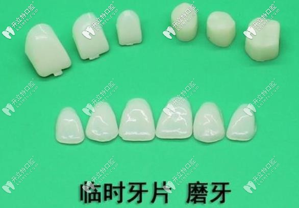 臨時(shí)牙貼面