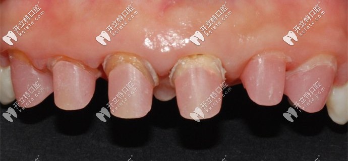 被磨掉1/2的基牙