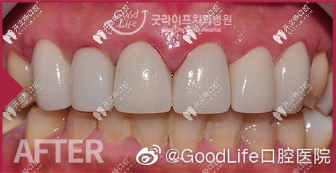 做完貼面后牙齒狀態(tài)