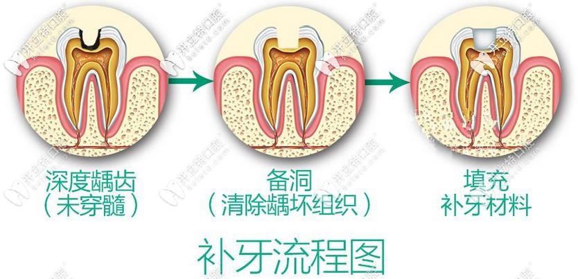 補牙攻略：3m和德國voco納米樹脂補牙哪個材料更好？