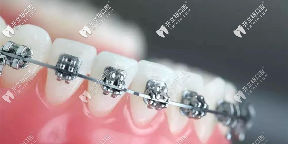 自鎖托槽矯正的方弓絲