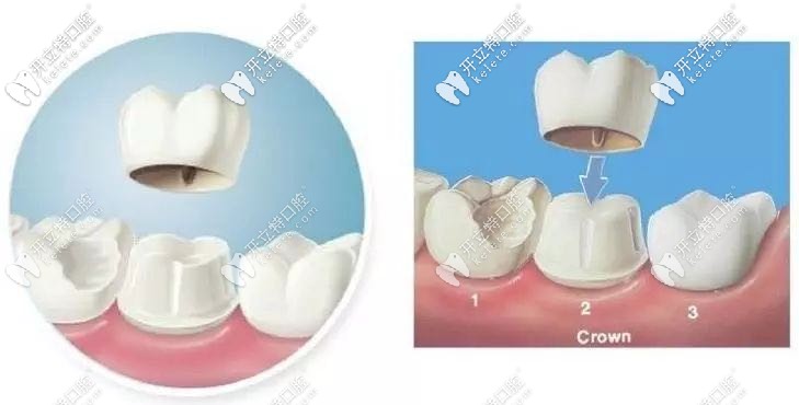 柏樂(lè)口腔鈷鉻牙冠