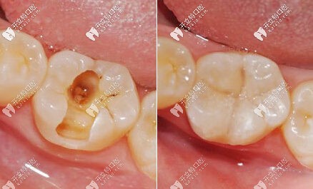補(bǔ)牙的前后對比圖
