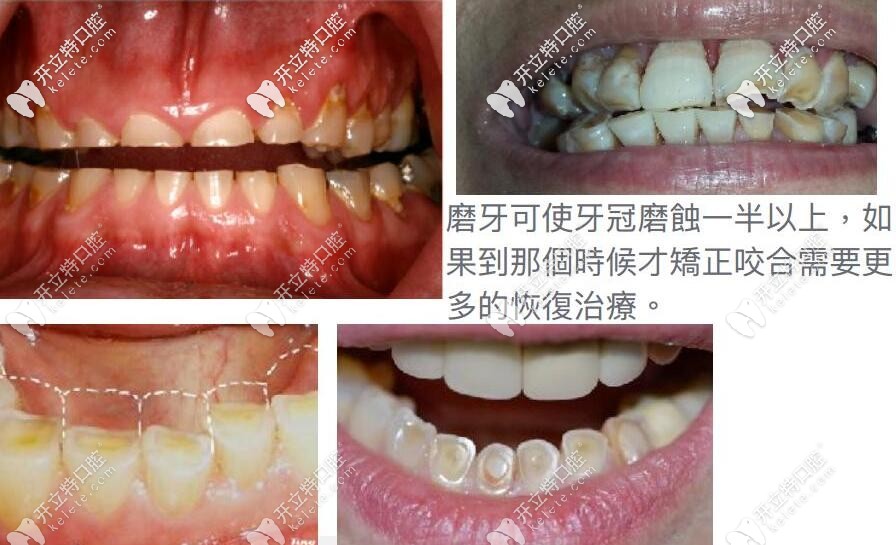 牙齒咬合不齊要及時(shí)矯正 牙齒咬合不齊要及時(shí)矯正