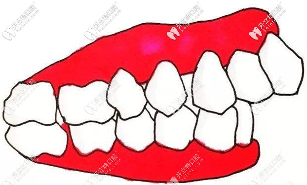 據(jù)說骨性齙牙自鎖托槽矯正用方絲比圓絲好,二者區(qū)別在哪？