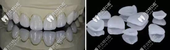 柏樂(lè)口腔全瓷牙齒貼面