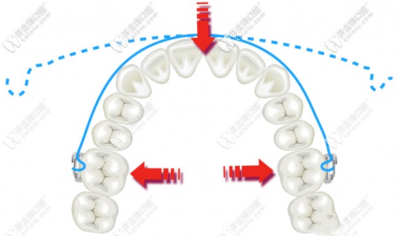 擴(kuò)弓可以輔助矯正器治療地包天