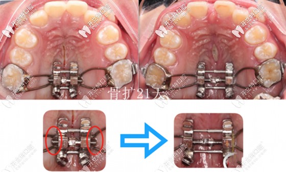 醫(yī)生多主張慢速擴(kuò)弓矯治