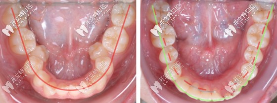 牙齒擴(kuò)弓矯正前后效果對(duì)比圖